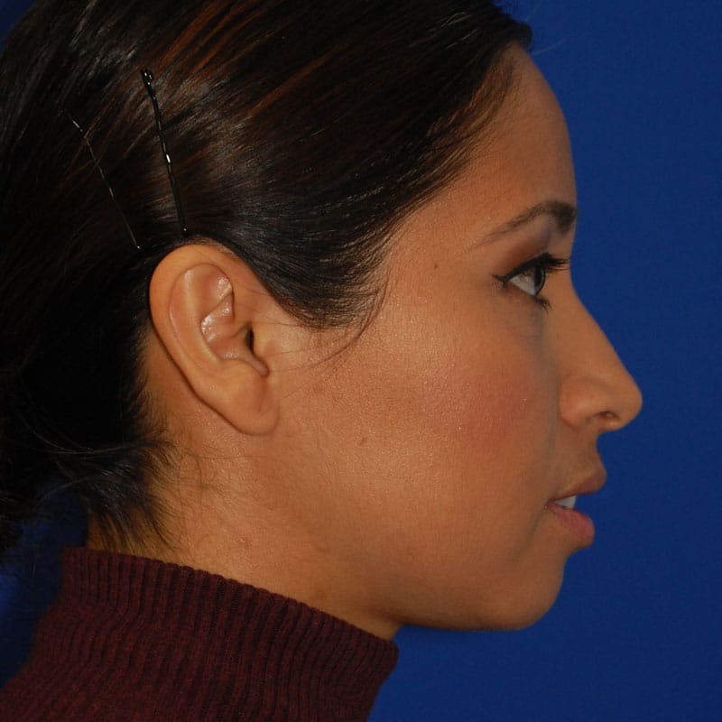 Chin Augmentation Before & After Gallery - Patient 425914 - Image 5