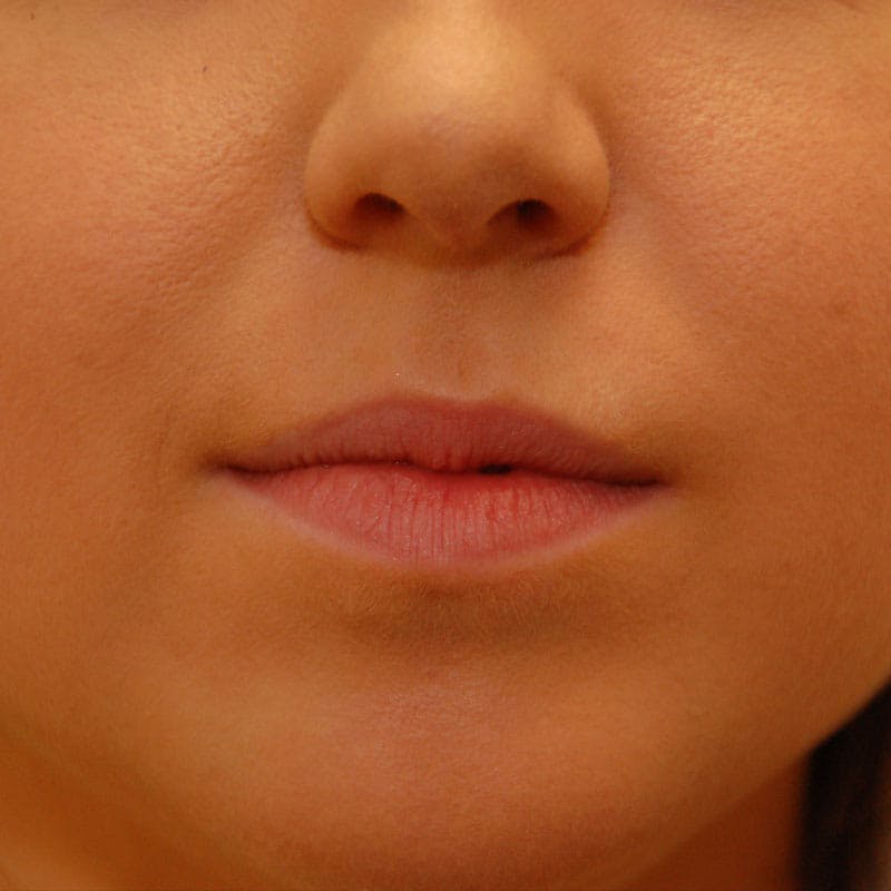 Lip Filler Before & After Gallery - Patient 582830 - Image 1