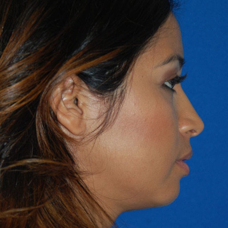 Chin Augmentation Before & After Gallery - Patient 425914 - Image 6