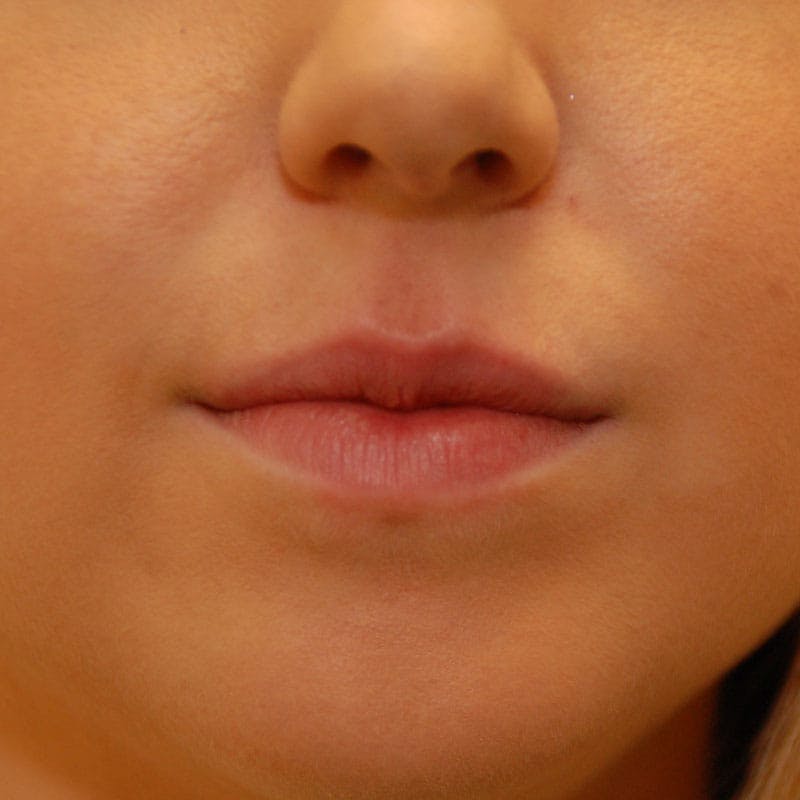 Lip Augmentation Before & After Gallery - Patient 582830 - Image 2