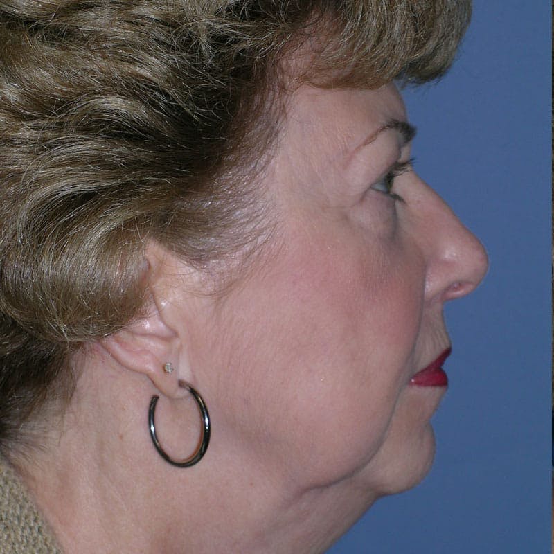 Facelift & Necklift Before & After Gallery - Patient 346696 - Image 5