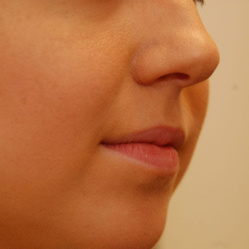 Lip Augmentation Before & After Gallery - Patient 582830 - Image 3