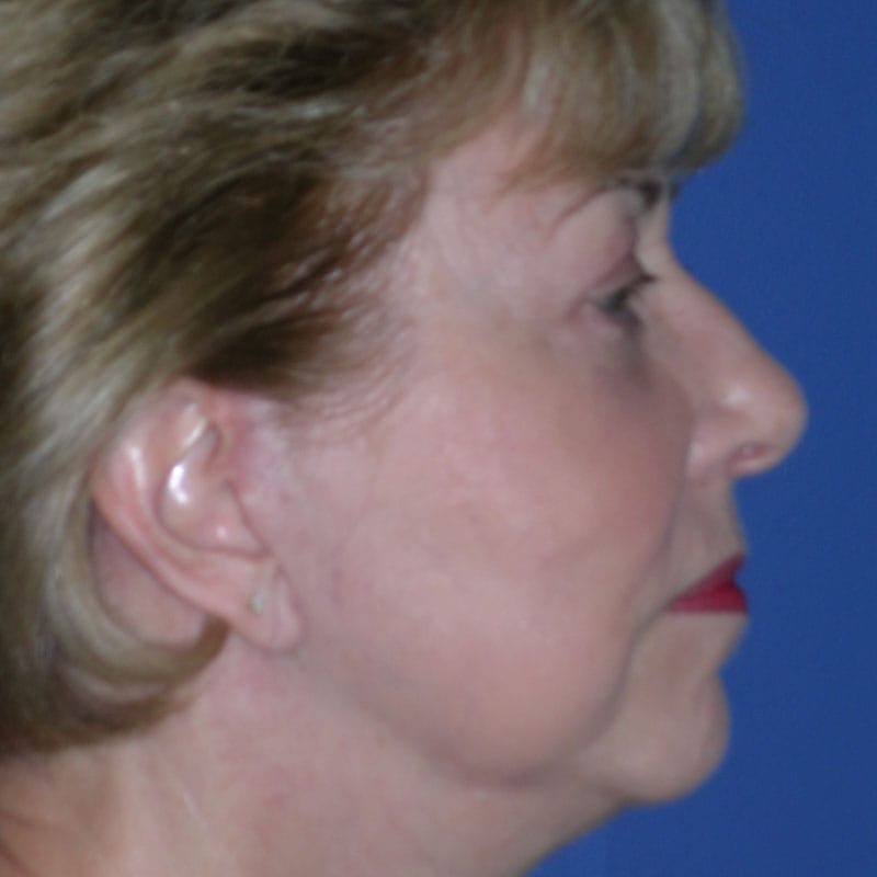 Facelift & Necklift Before & After Gallery - Patient 346696 - Image 6