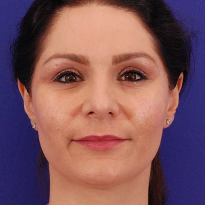 Ethnic Rhinoplasty Before & After Gallery - Patient 321357 - Image 2