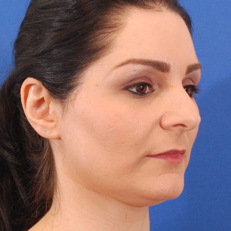 Ethnic Rhinoplasty Before & After Gallery - Patient 321357 - Image 5