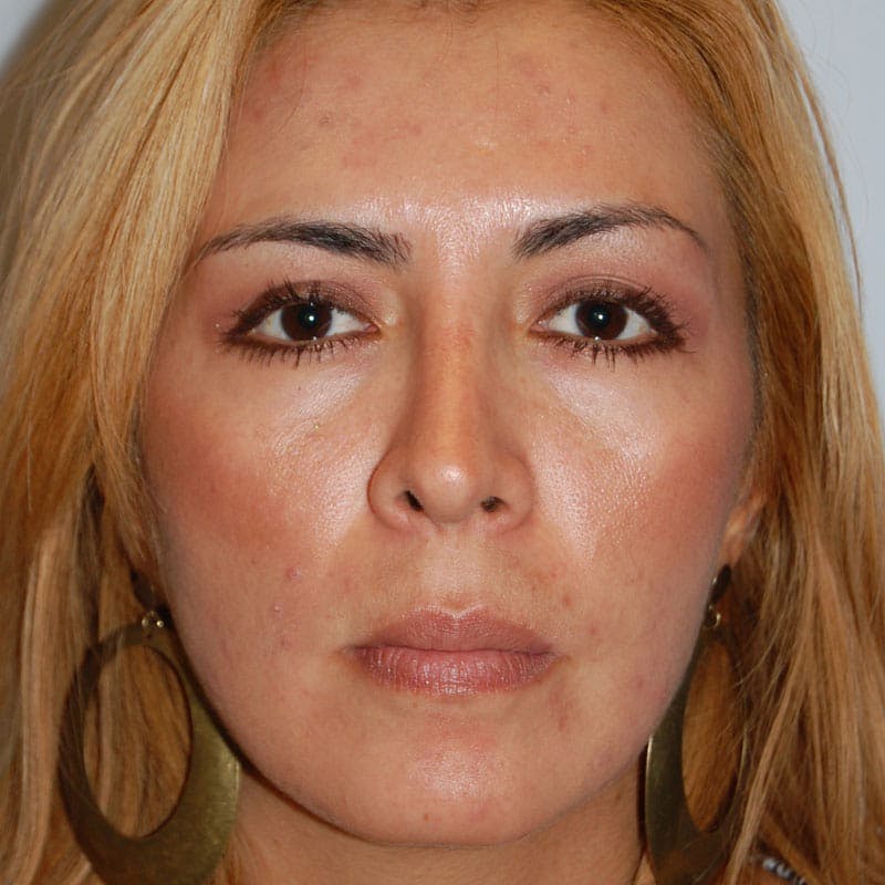 Ethnic Rhinoplasty Before & After Gallery - Patient 280526 - Image 4