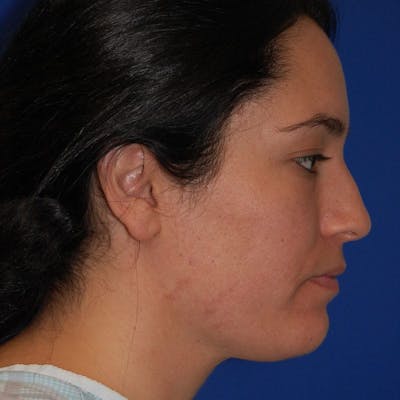 Dorsal Hump Before & After Gallery - Patient 412358 - Image 1