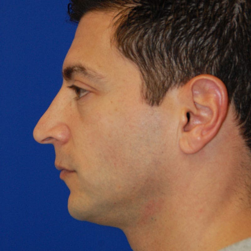 Long Nose Before & After Gallery - Patient 128479 - Image 5