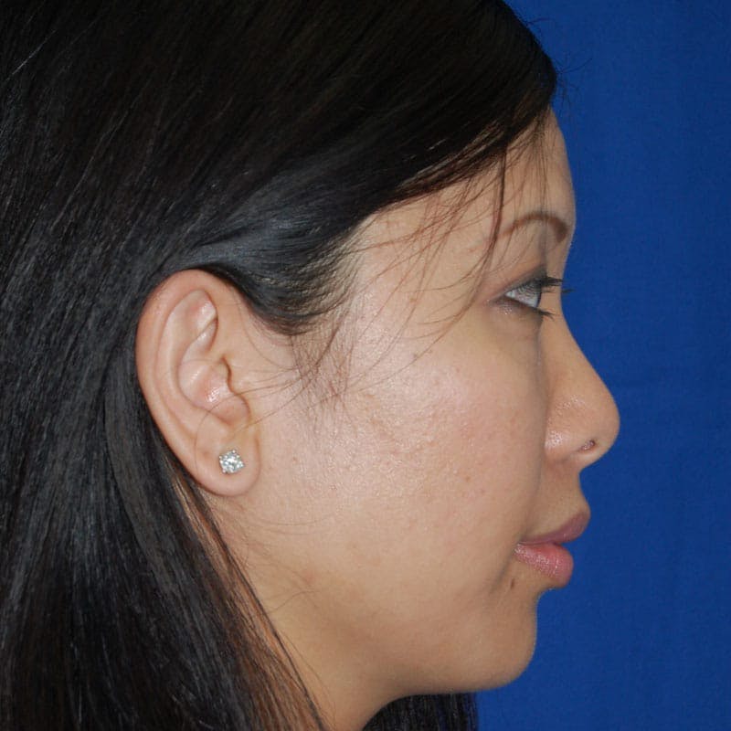 Short Nose Before & After Gallery - Patient 772156 - Image 5