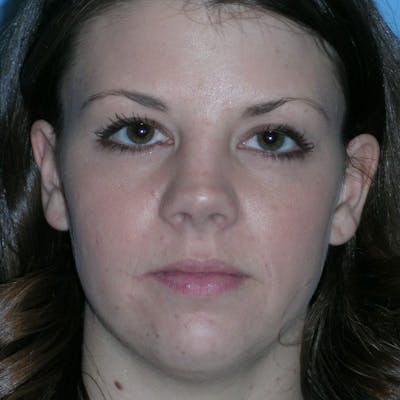 Short Nose Before & After Gallery - Patient 344255 - Image 1