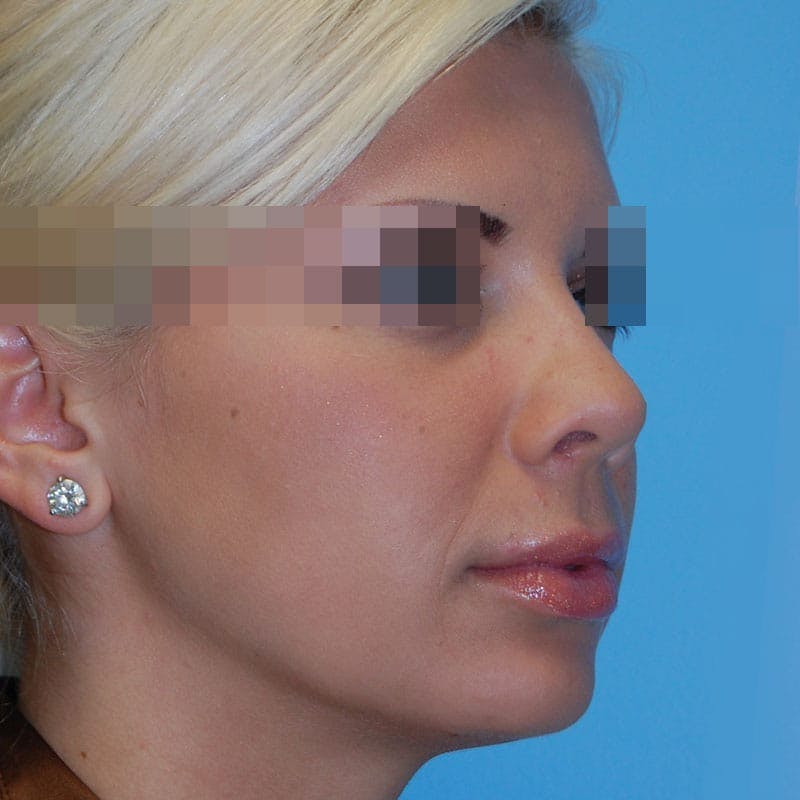 Wide Nose Before & After Gallery - Patient 207759 - Image 4