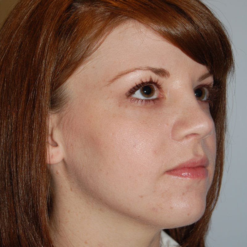 Short Nose Before & After Gallery - Patient 344255 - Image 4