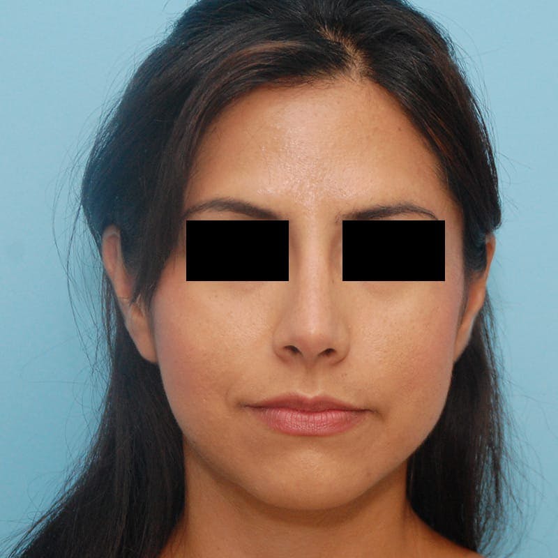 Ethnic Rhinoplasty Before & After Gallery - Patient 245623 - Image 4