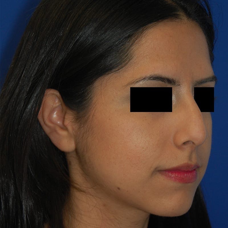 Ethnic Rhinoplasty Before & After Gallery - Patient 245623 - Image 5