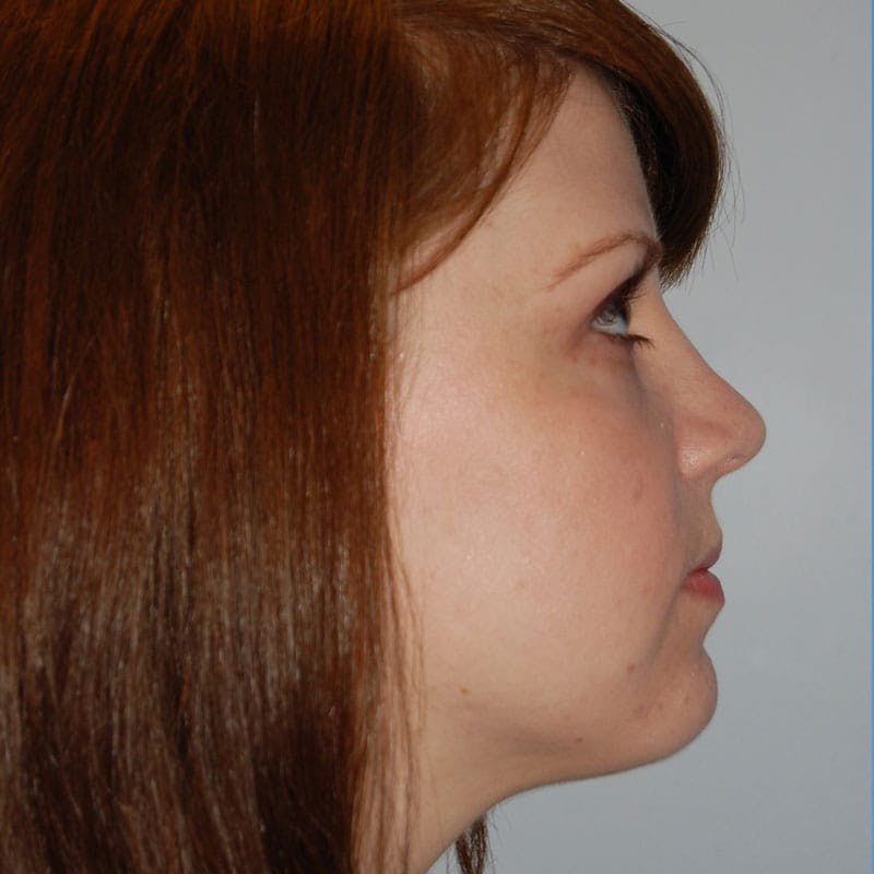 Short Nose Before & After Gallery - Patient 344255 - Image 6