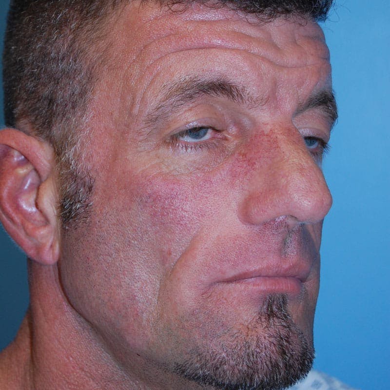 Wide Nose Before & After Gallery - Patient 534065 - Image 3