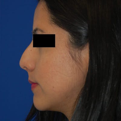 Ethnic Rhinoplasty Before & After Gallery - Patient 245623 - Image 1