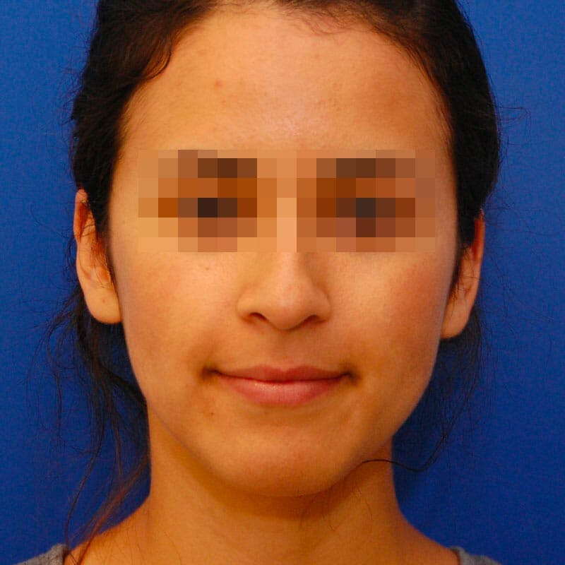 Small Changes Before & After Gallery - Patient 327496 - Image 1