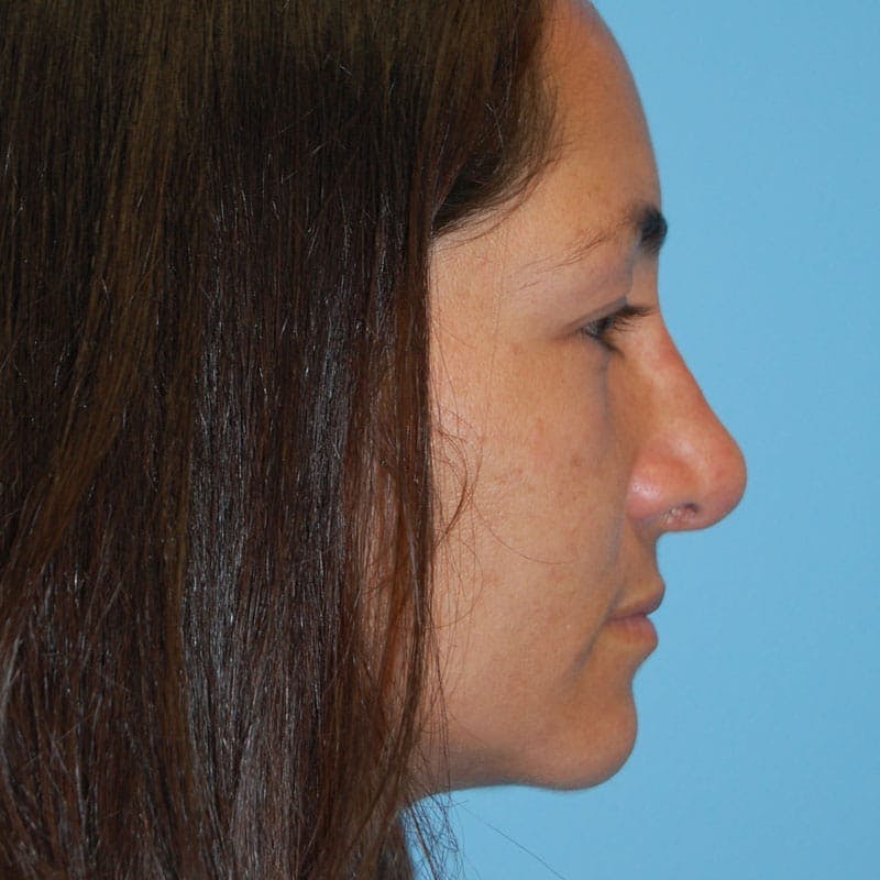 Wide Nose Before & After Gallery - Patient 351930 - Image 6