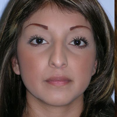 Long Nose Before & After Gallery - Patient 176346 - Image 1