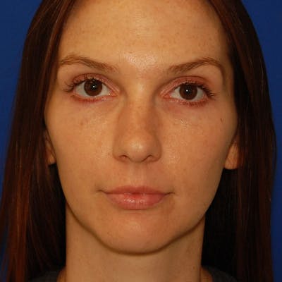 Crooked Nose Before & After Gallery - Patient 366711 - Image 1