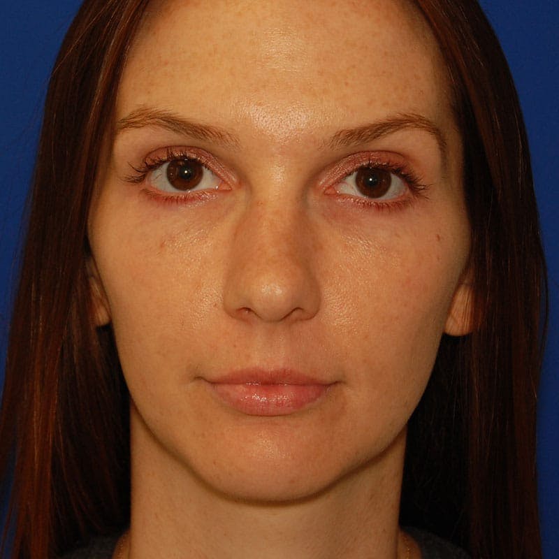 Crooked Nose Before & After Gallery - Patient 366711 - Image 1