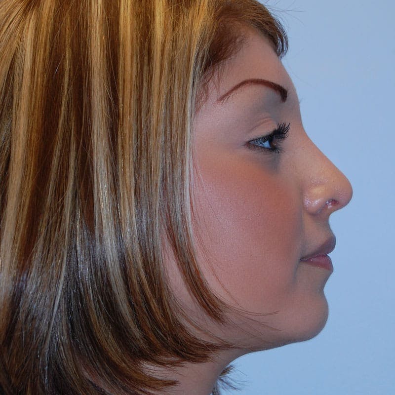 Long Nose Before & After Gallery - Patient 176346 - Image 6