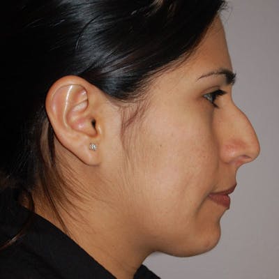 Dorsal Hump Before & After Gallery - Patient 145415 - Image 1