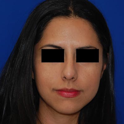 Crooked Nose Before & After Gallery - Patient 885608 - Image 1