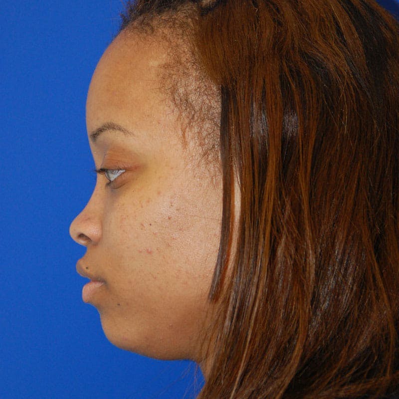 Wide Nose Before & After Gallery - Patient 296282 - Image 5