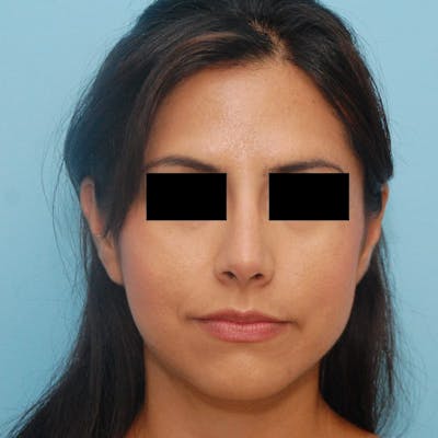 Crooked Nose Before & After Gallery - Patient 885608 - Image 2