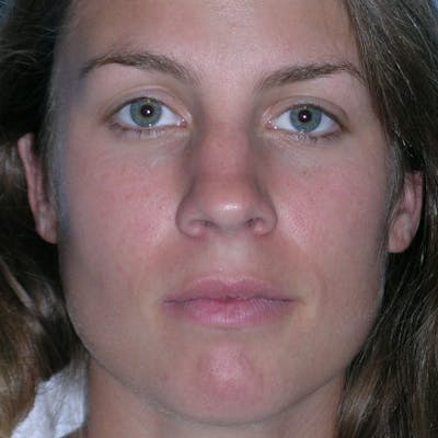 Wide Nose Before & After Gallery - Patient 416596 - Image 1