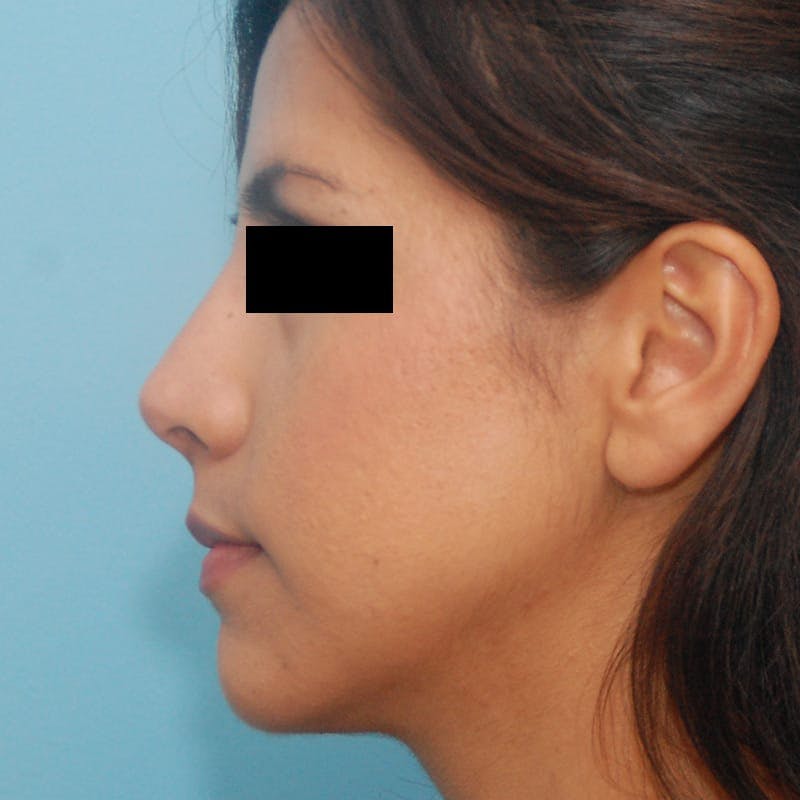 Dorsal Hump Before & After Gallery - Patient 359453 - Image 6