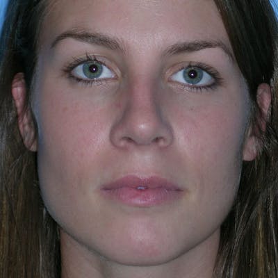Wide Nose Before & After Gallery - Patient 416596 - Image 2
