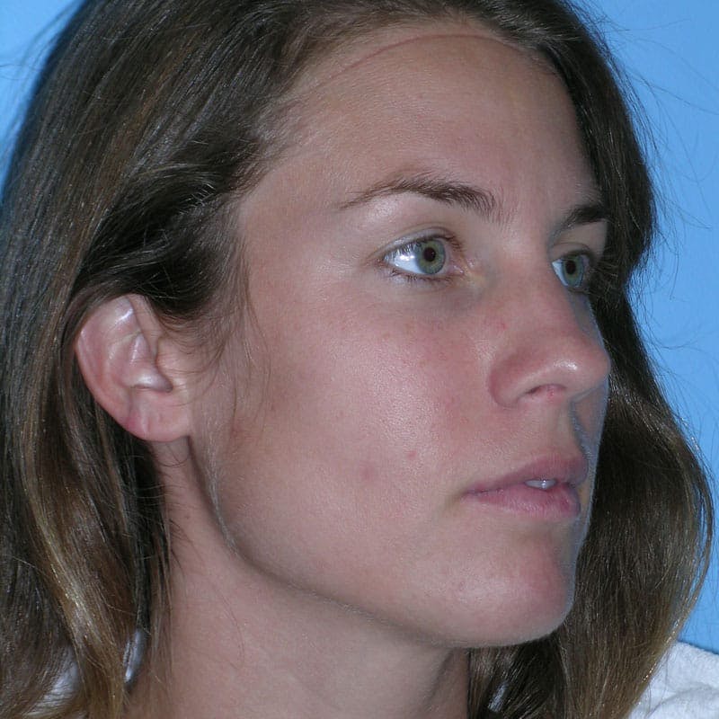 Wide Nose Before & After Gallery - Patient 416596 - Image 3