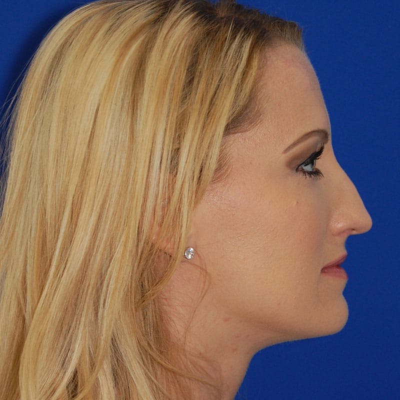 Long Nose Before & After Gallery - Patient 350061 - Image 5