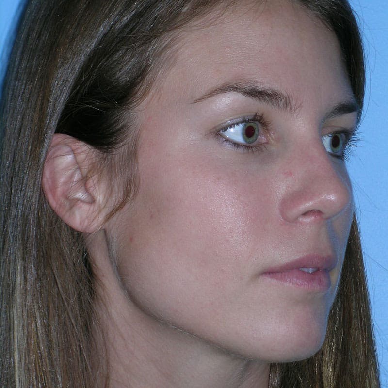 Wide Nose Before & After Gallery - Patient 416596 - Image 4