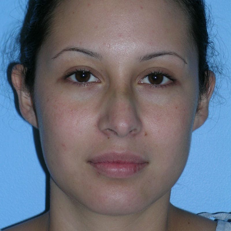 Revision Rhinoplasty Before & After Gallery - Patient 236303 - Image 3