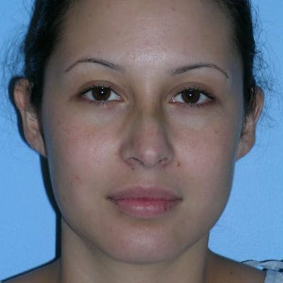 Revision Rhinoplasty Before & After Gallery - Patient 236303 - Image 1