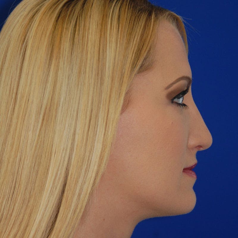 Long Nose Before & After Gallery - Patient 350061 - Image 6