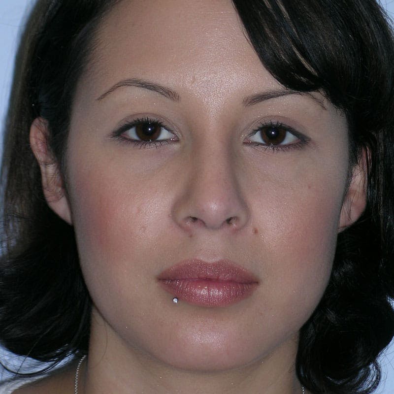 Revision Rhinoplasty Before & After Gallery - Patient 236303 - Image 4