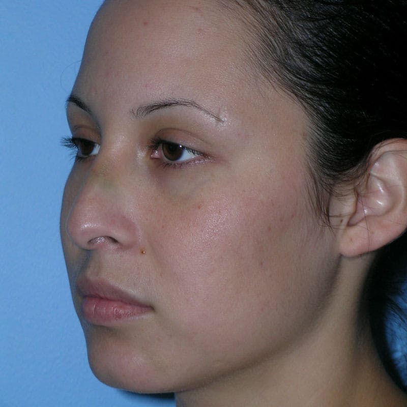 Revision Rhinoplasty Before & After Gallery - Patient 236303 - Image 5