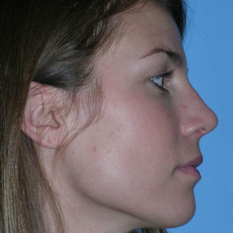 Wide Nose Before & After Gallery - Patient 416596 - Image 6