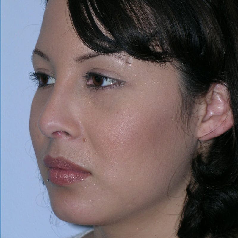 Revision Rhinoplasty Before & After Gallery - Patient 236303 - Image 6