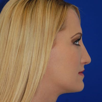 Dorsal Hump Before & After Gallery - Patient 262297 - Image 2