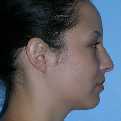 Revision Rhinoplasty Before & After Gallery - Patient 236303 - Image 1