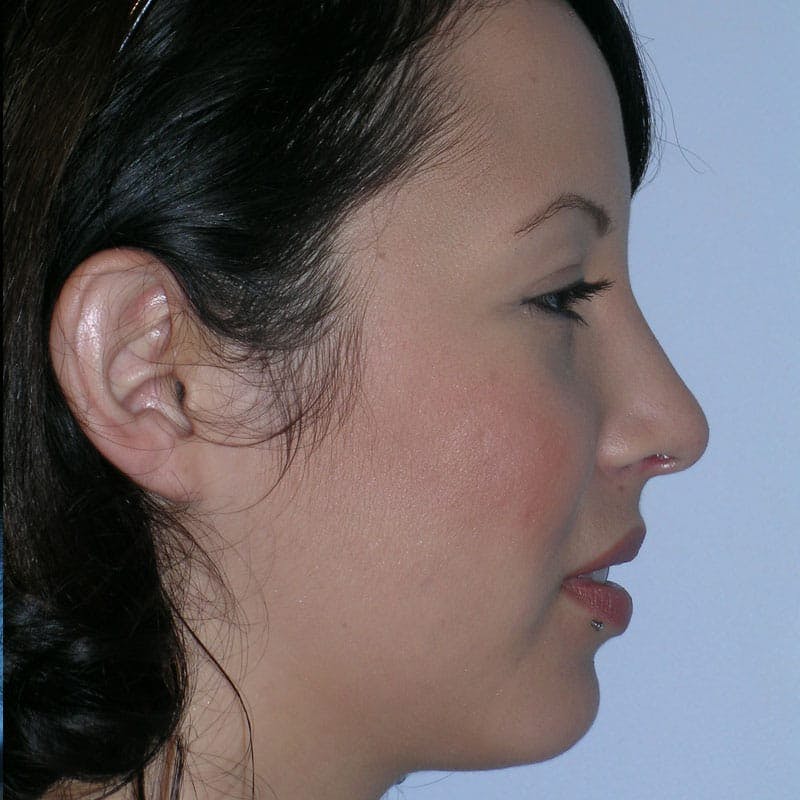 Revision Rhinoplasty Before & After Gallery - Patient 236303 - Image 2