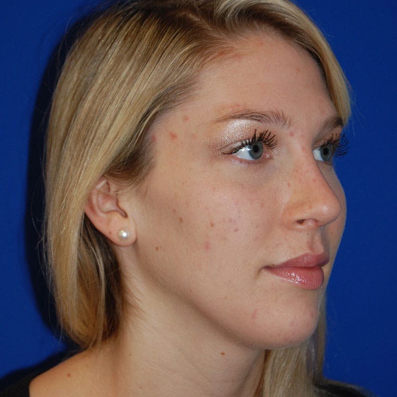 Wide Nose Before & After Gallery - Patient 254126 - Image 4