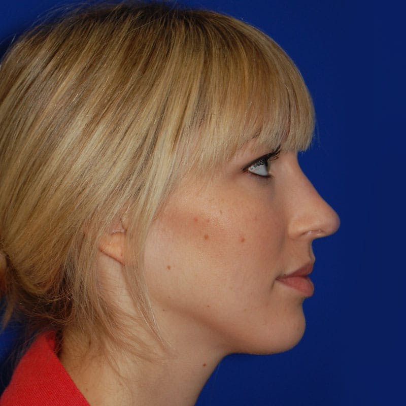 Wide Nose Before & After Gallery - Patient 254126 - Image 5