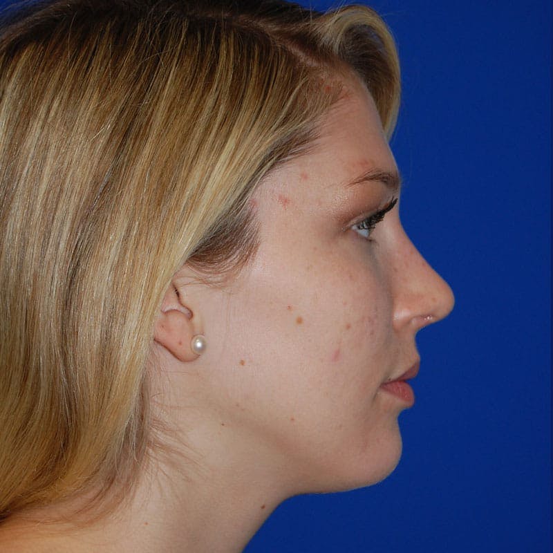Wide Nose Before & After Gallery - Patient 254126 - Image 6